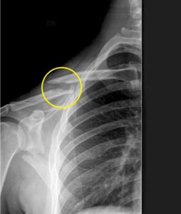 Immagine radiografica della frattura di clavicola