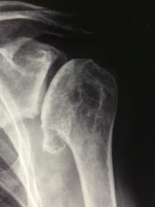 Immagine radiografica dell'artrosi di spalla